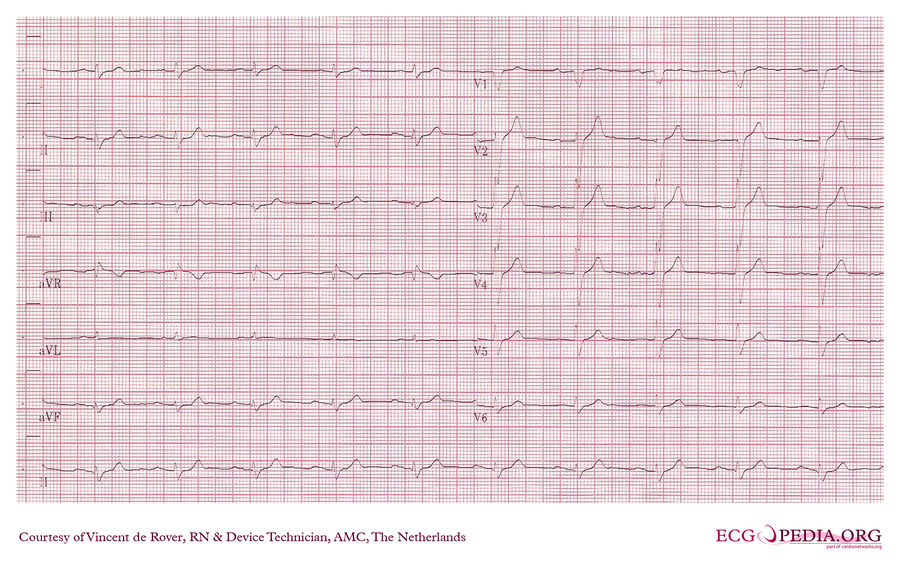 AMC Case 171 - ECGpedia