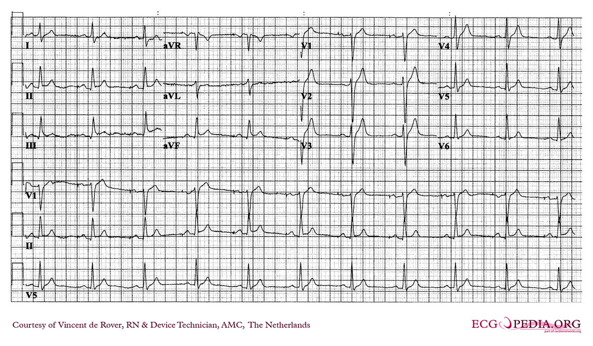 Amc Case 228 - Ecgpedia