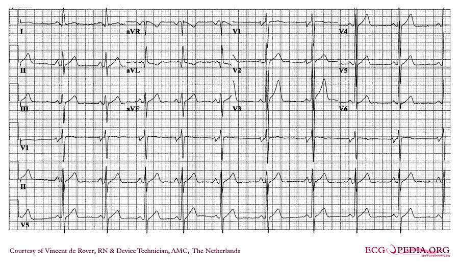 AMC Case 229 - ECGpedia