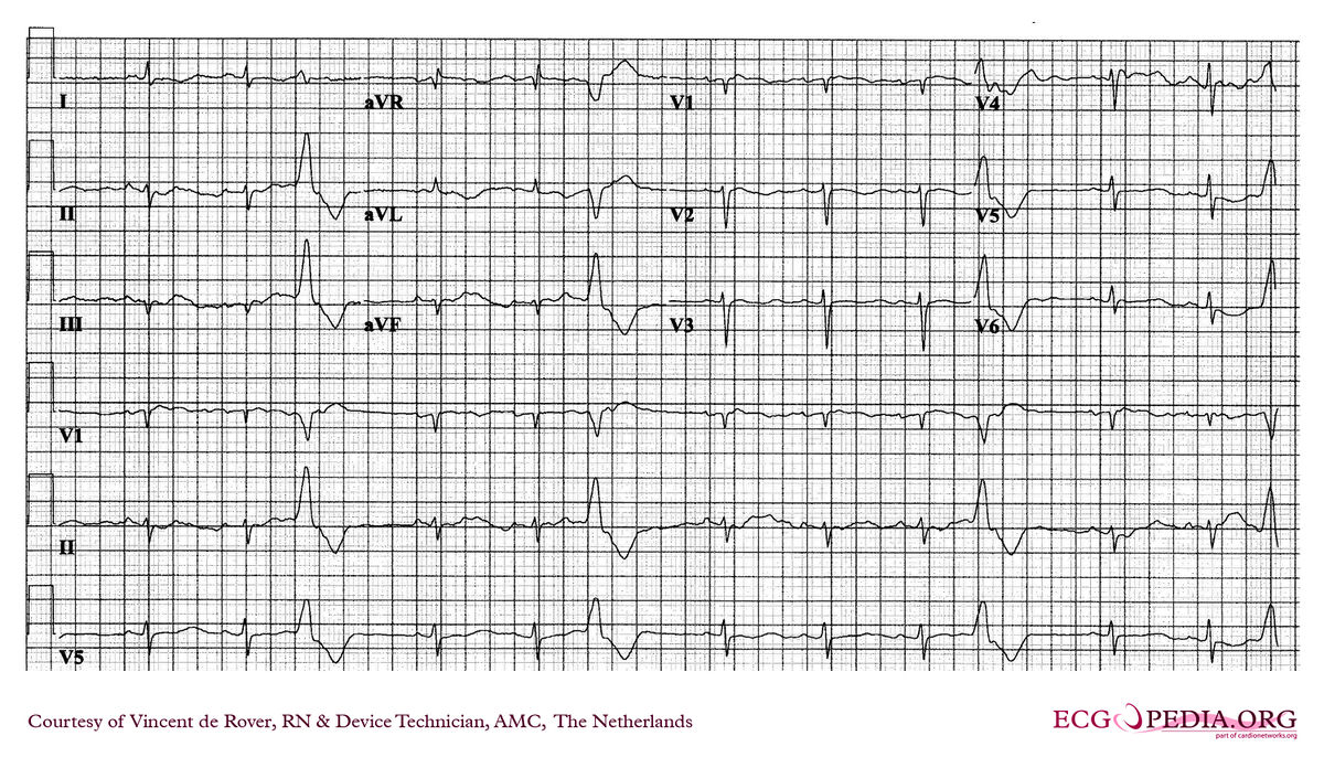 AMC Case 239 - ECGpedia