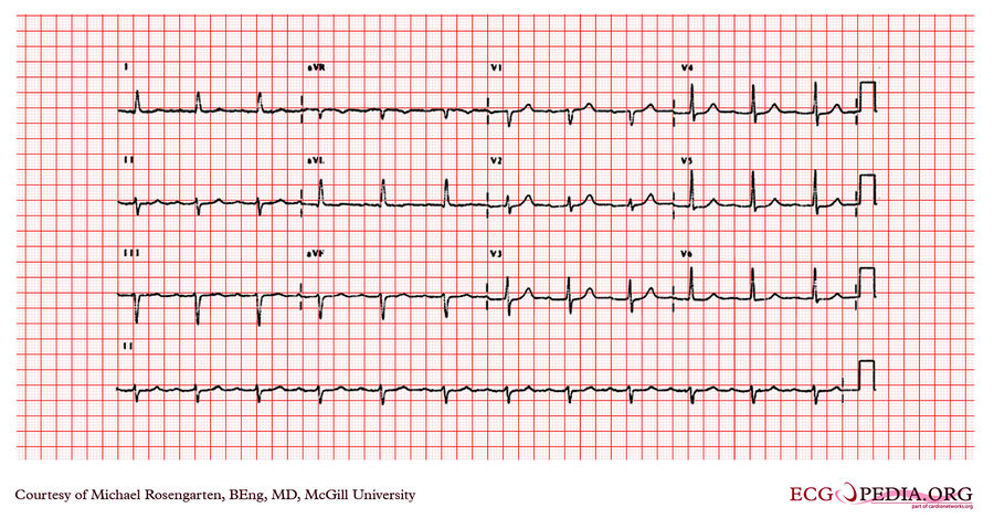 McGill Case 33 - ECGpedia