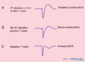 File:V4R occlusion.svg - ECGpedia