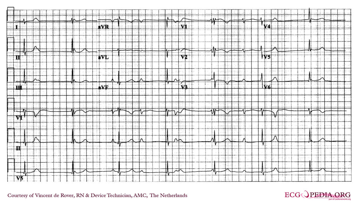 AMC Case 238 - ECGpedia