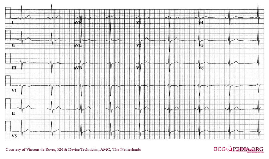 AMC Case 263 - ECGpedia