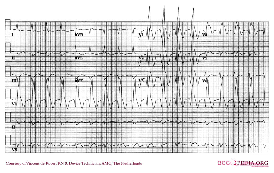 AMC Case 55 - ECGpedia