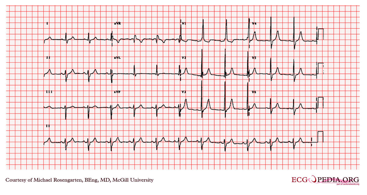 McGill Case 326 - ECGpedia