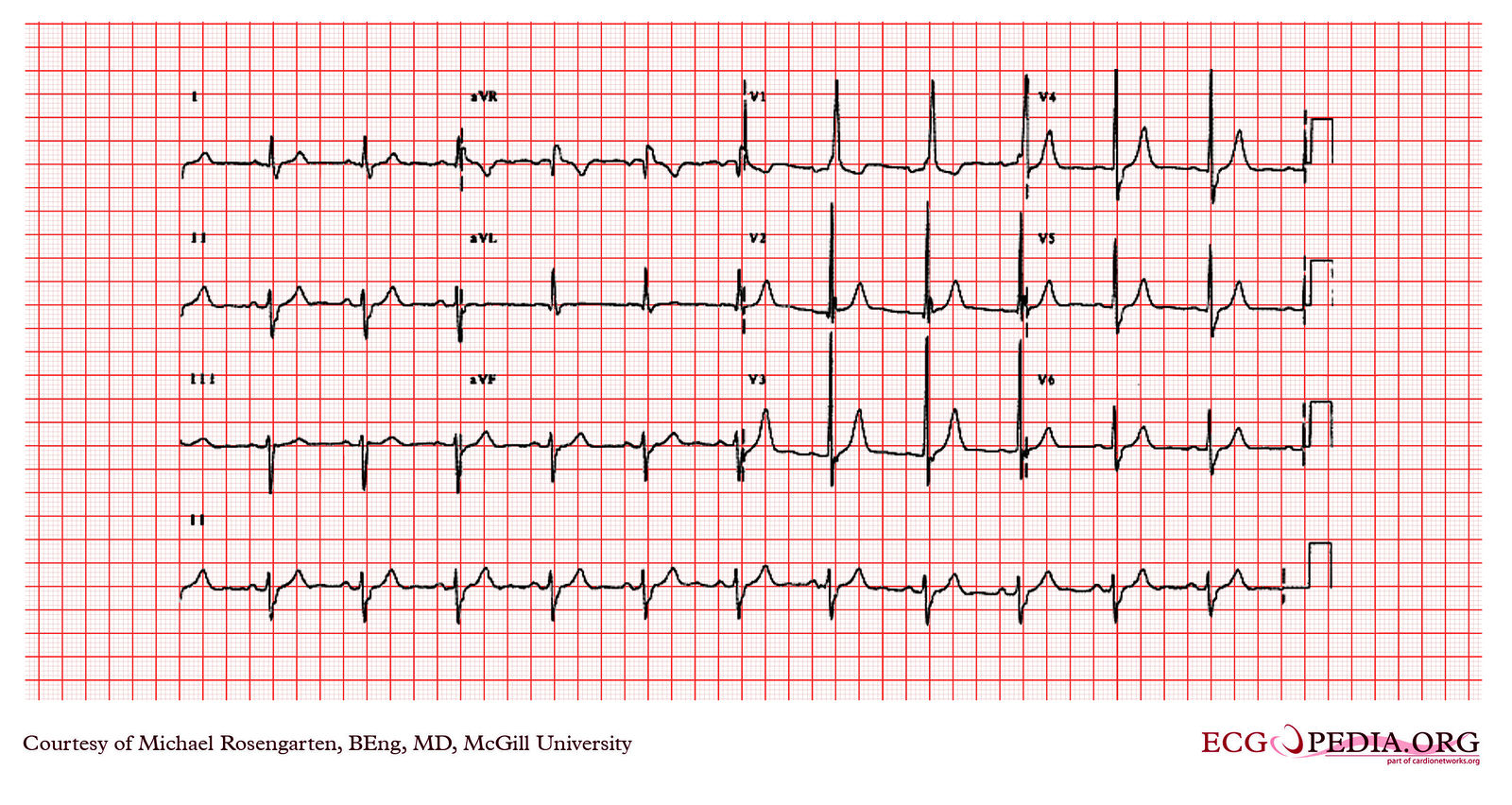 File:E326.jpg - ECGpedia