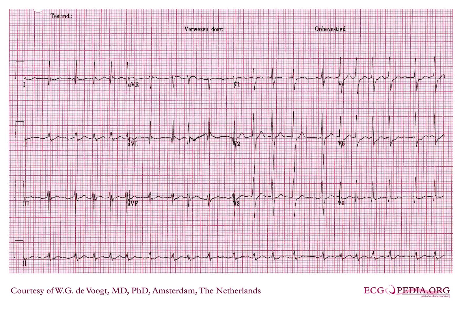 File:DVA0791.jpg - ECGpedia