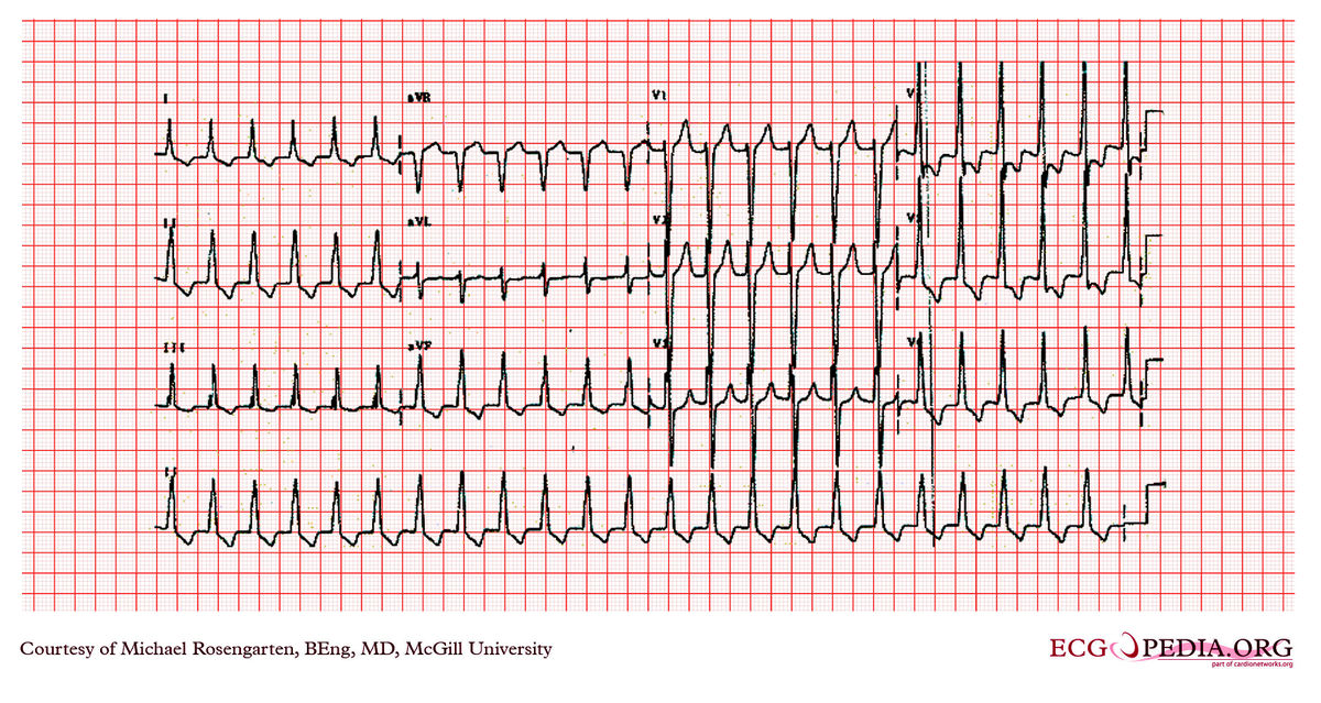 McGill Case 338 - ECGpedia