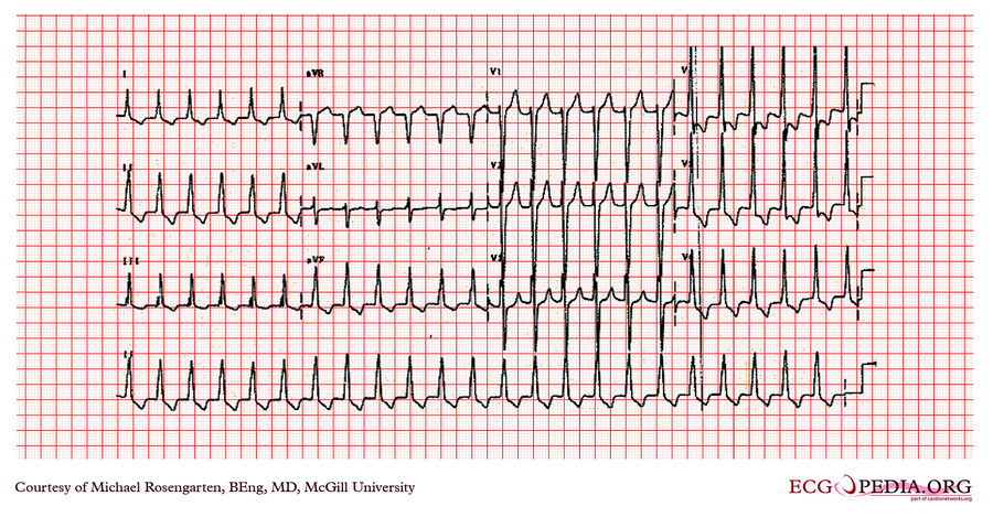 Mcgill Case 338 - Ecgpedia