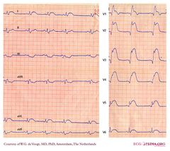 De Voogt ECG Archive - Intraventricular Conduction - ECGpedia