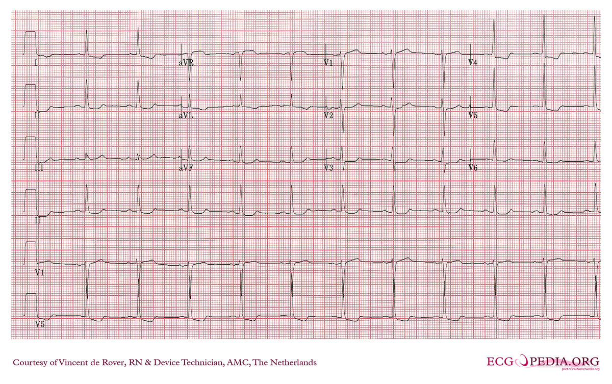 AMC Case 21 - ECGpedia