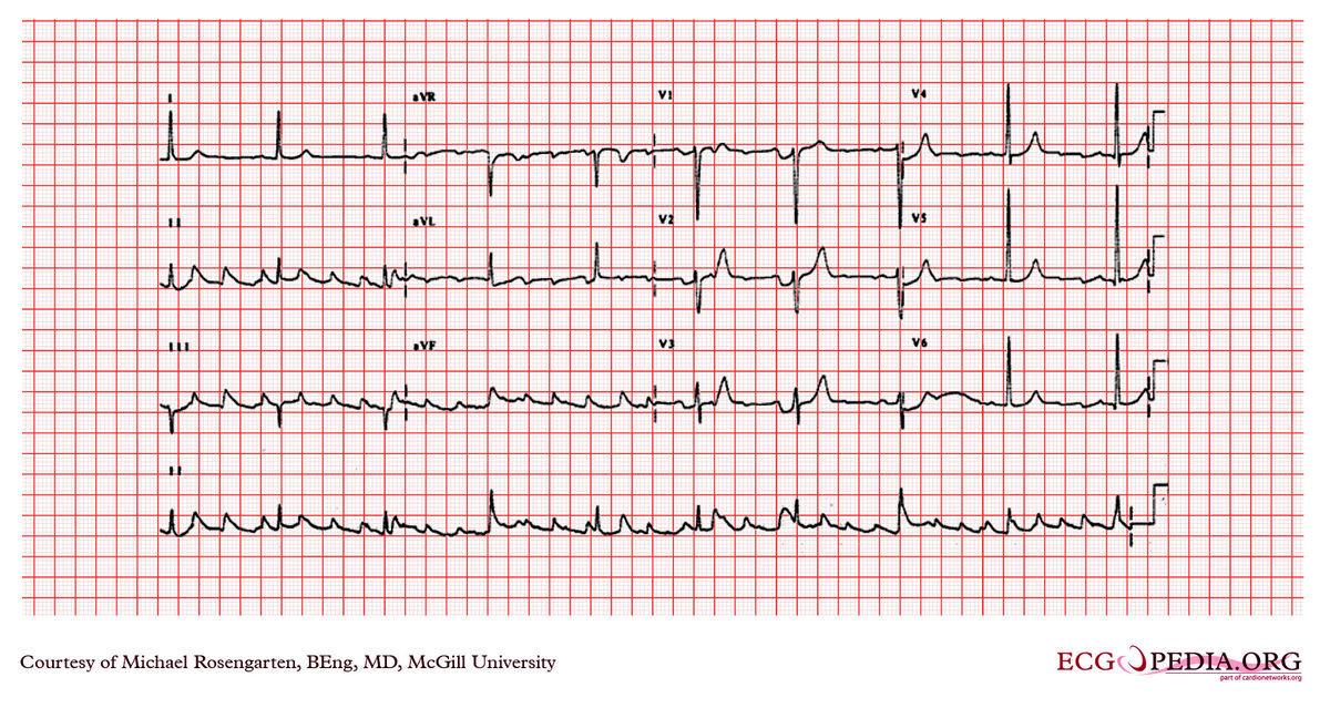 McGill Case 227 - ECGpedia