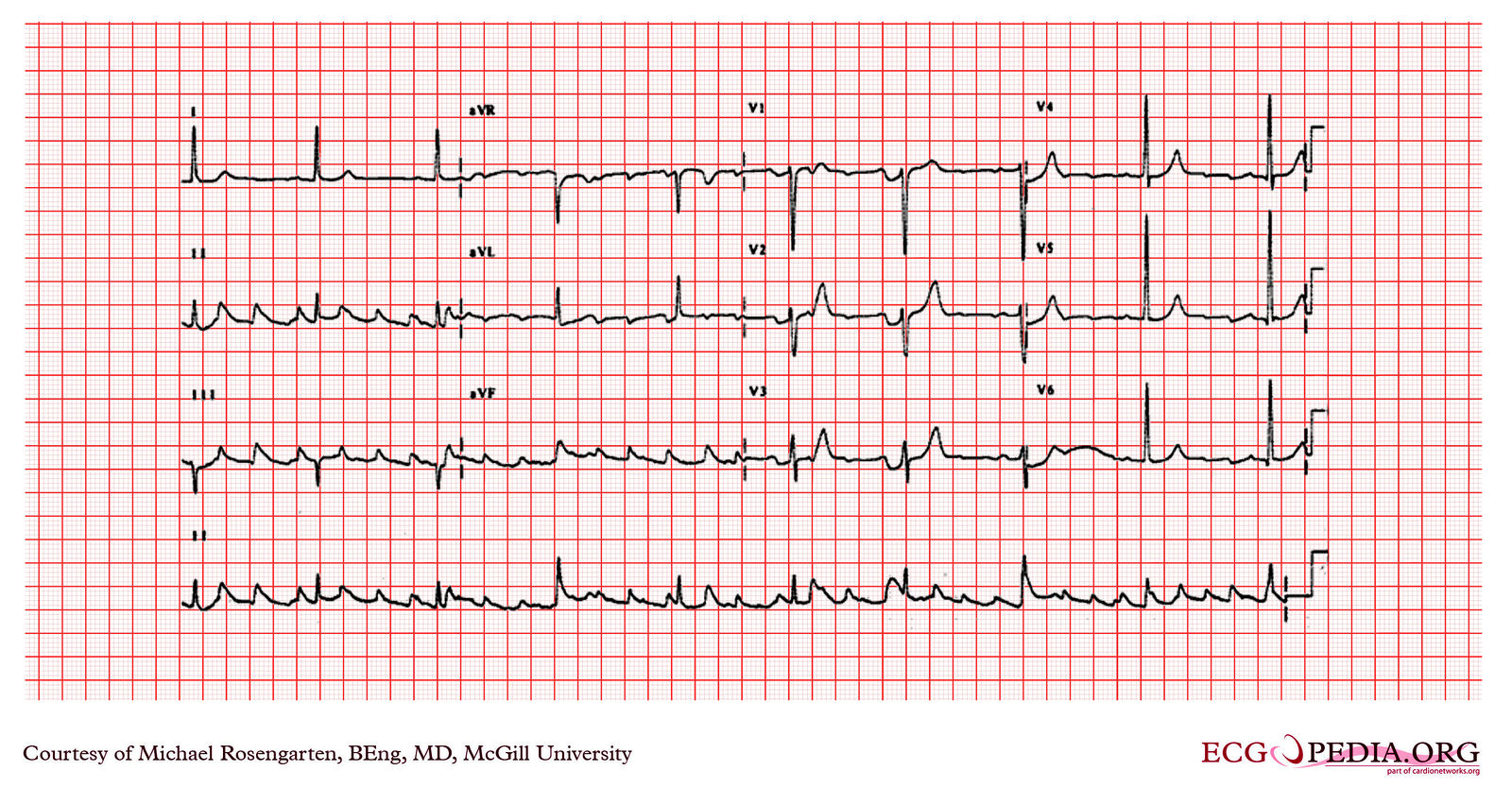 File:E227.jpg - ECGpedia