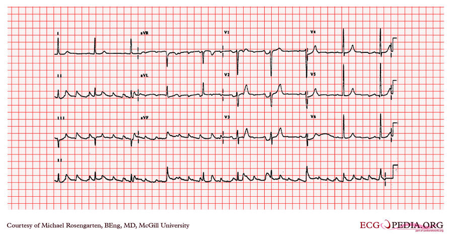 McGill Case 227 - ECGpedia