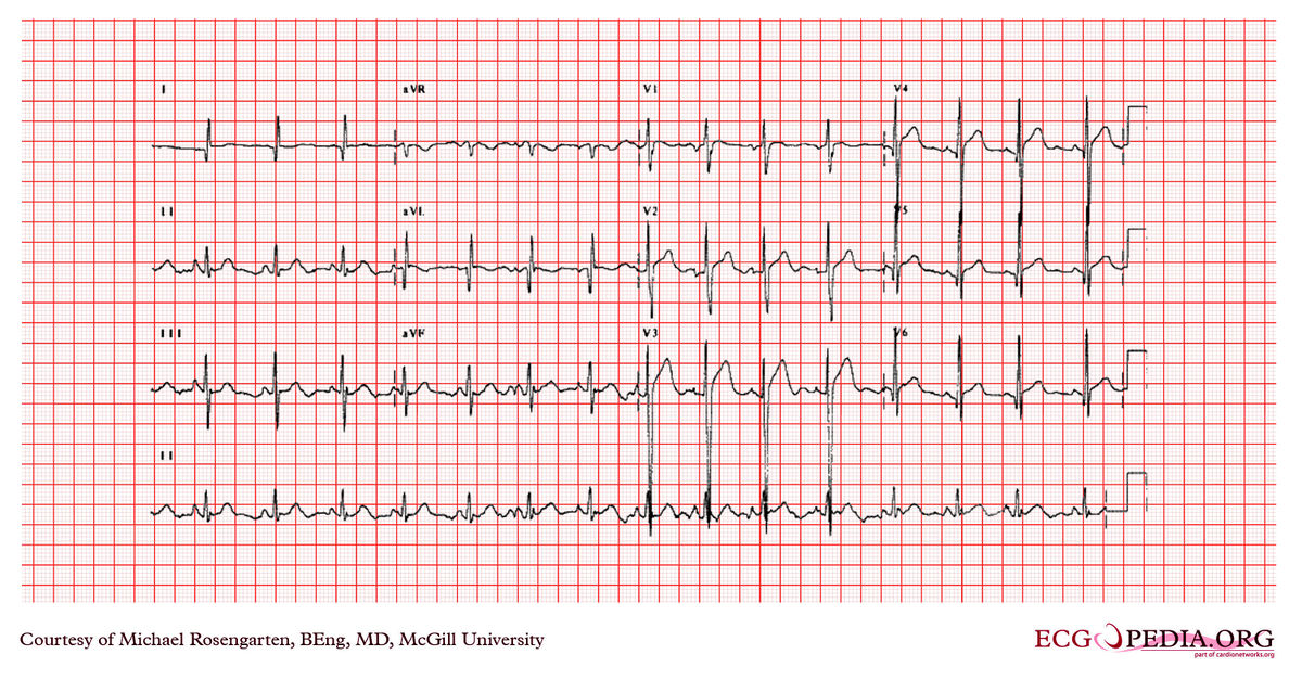 McGill Case 370 - ECGpedia