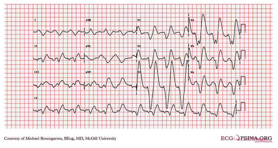 McGill Case 298 - ECGpedia