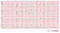 Case 2a: RBBB with anterior myocardial infarction. ST elevation in V2-V3.