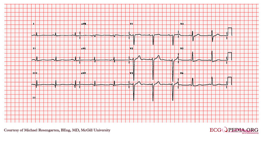 McGill Case 236 - ECGpedia