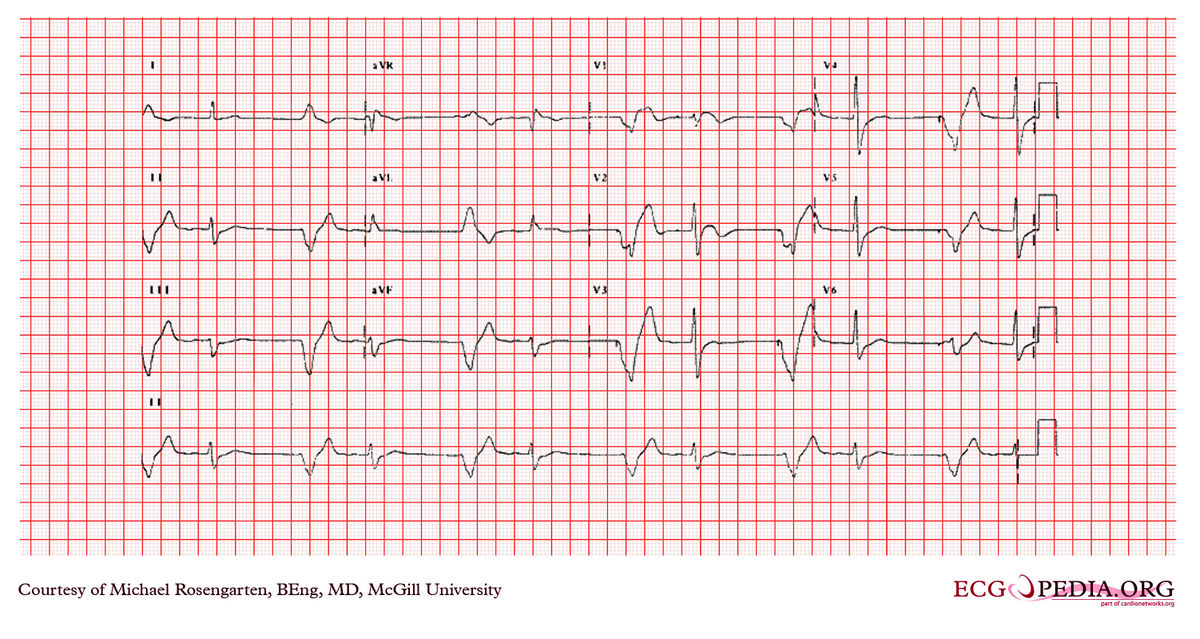 McGill Case 371 - ECGpedia