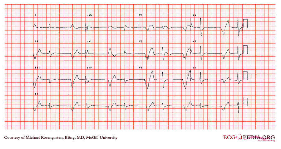 McGill Case 371 - ECGpedia