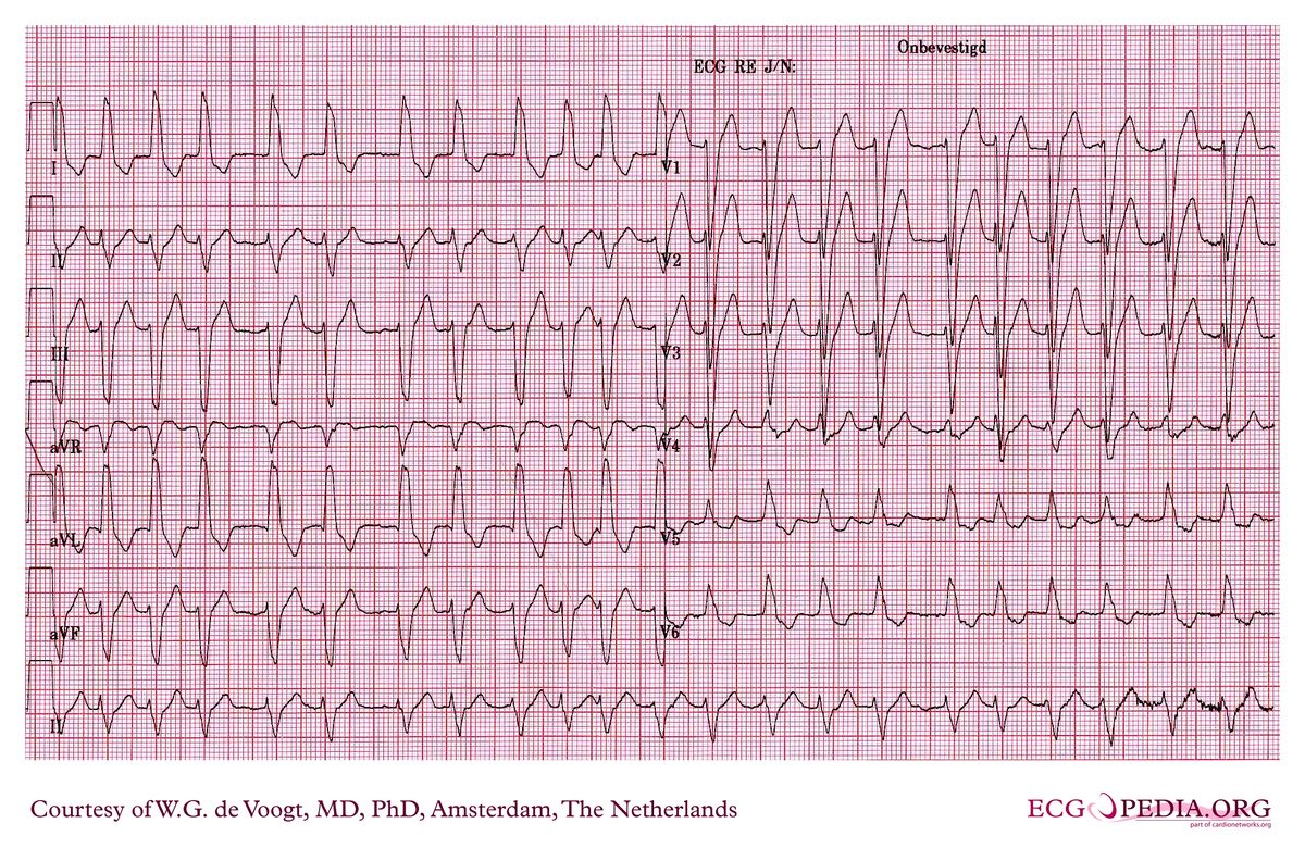 File:DVA0173.jpg - ECGpedia