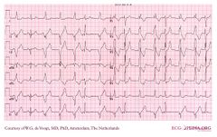 De Voogt ECG Archive - Myocardial Infarction - Inferior - ECGpedia