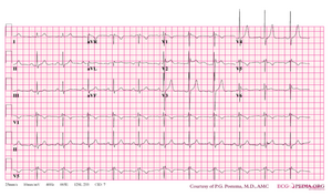 De-Brugada syndrome type2 example1.png