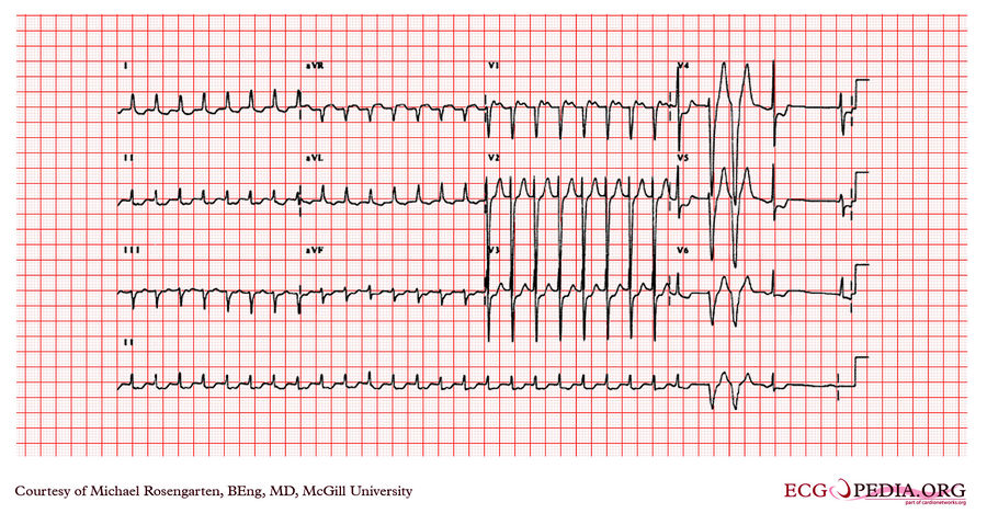 McGill Case 345 - ECGpedia