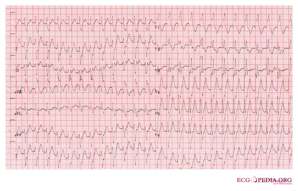 Example 26 - ECGpedia