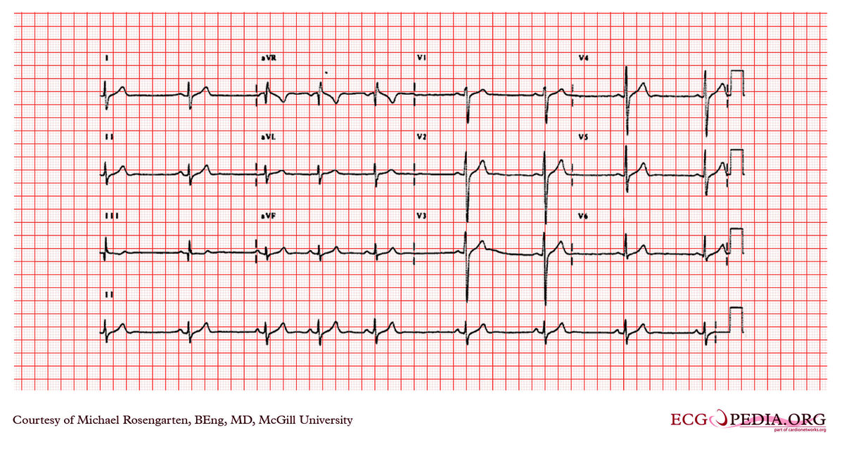 Mcgill Case 17 - Ecgpedia