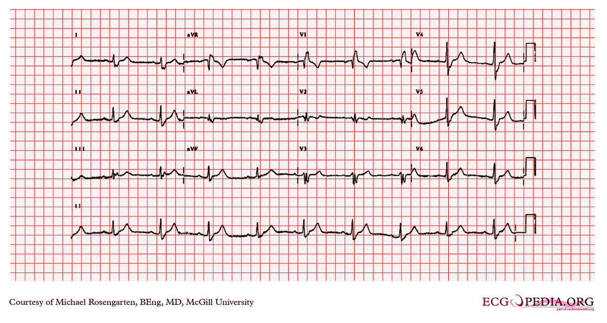 McGill Case 24 - ECGpedia