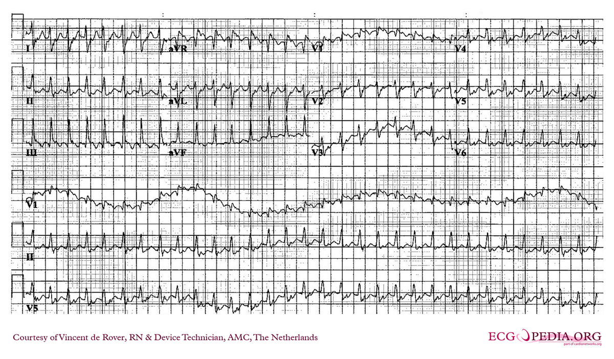 AMC Case 117 - ECGpedia