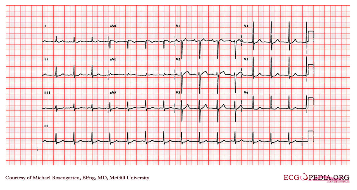 McGill Case 55 - ECGpedia