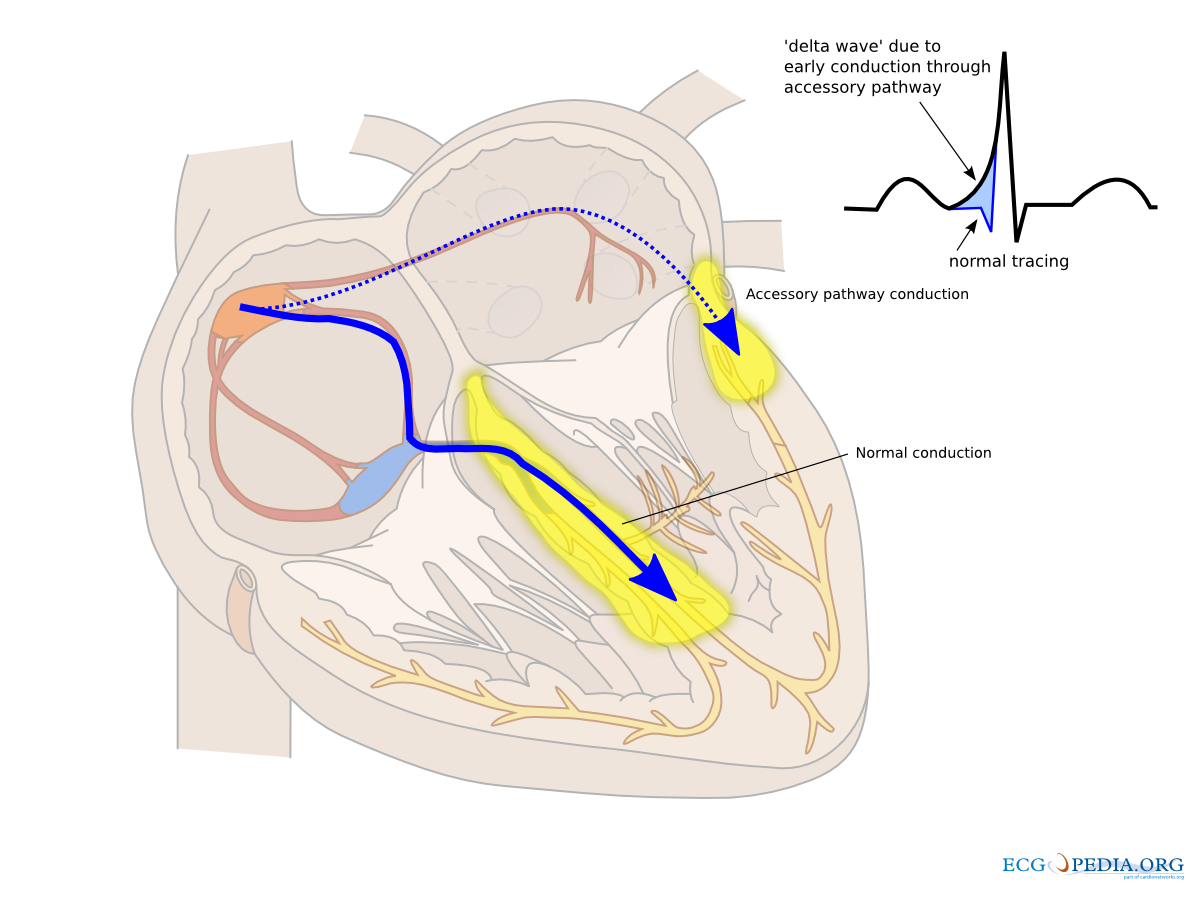 File:wpw2.svg - Ecgpedia