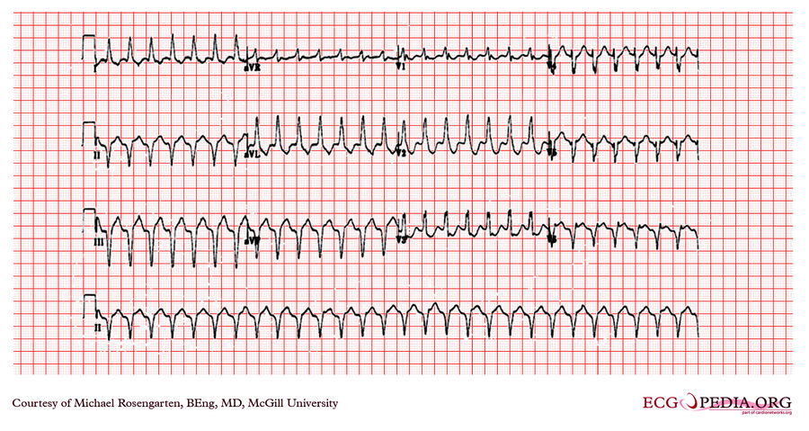 McGill Case 89 - ECGpedia