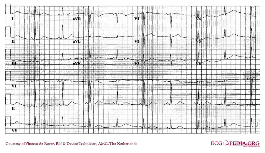 AMC Case 162 - ECGpedia