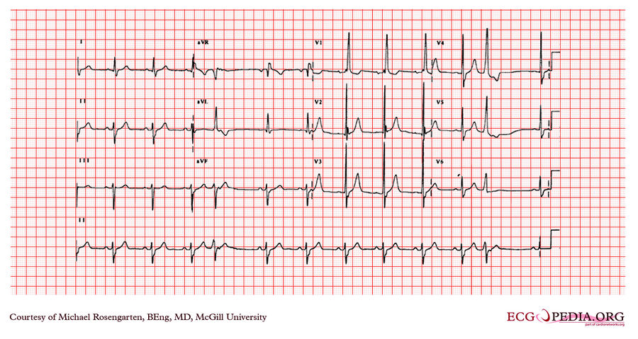 McGill Case 19 - ECGpedia