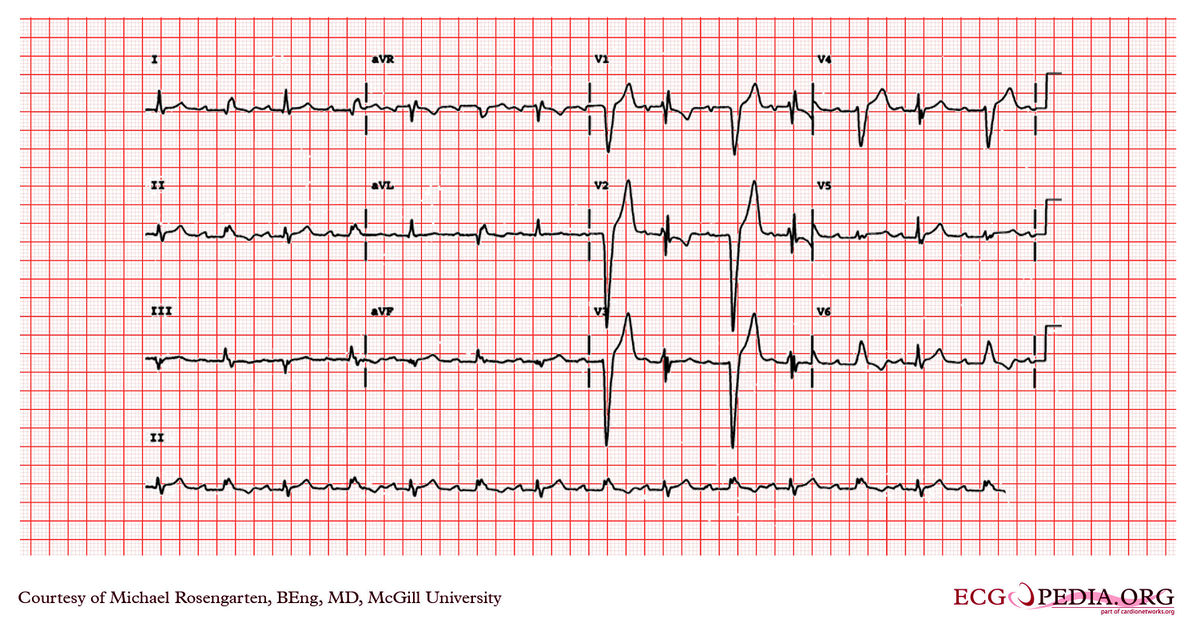 McGill Case 25 - ECGpedia