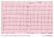 De Voogt Ecg Archive - Intraventricular Conduction - Ecgpedia