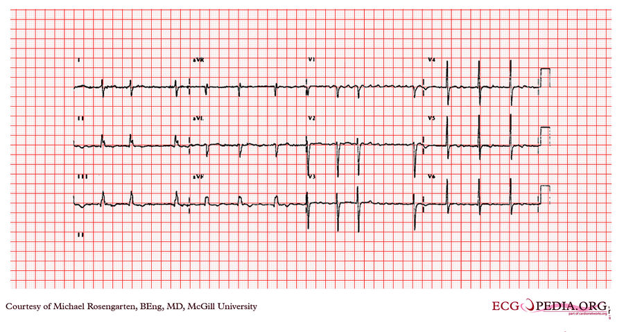 McGill Case 66 - ECGpedia