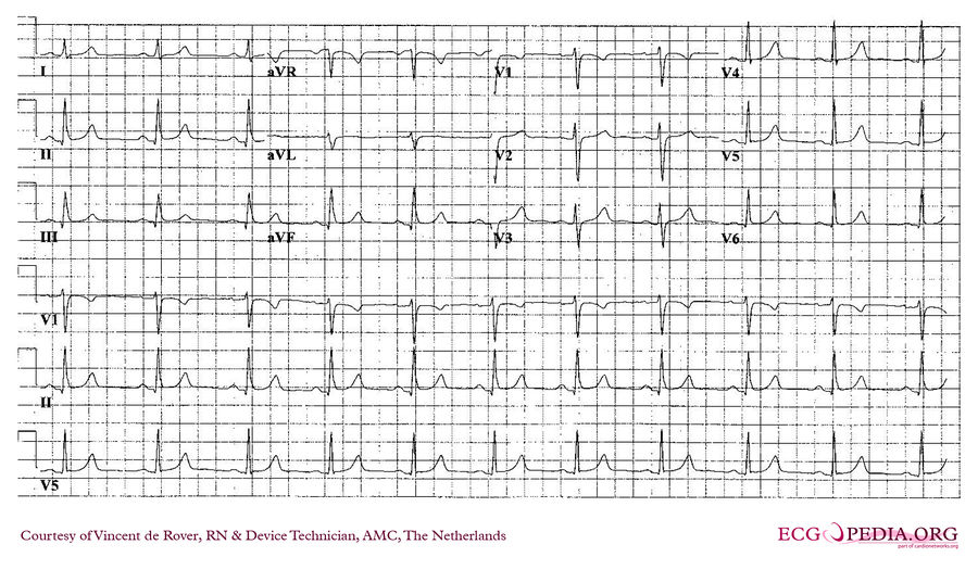 AMC Case 27 - ECGpedia