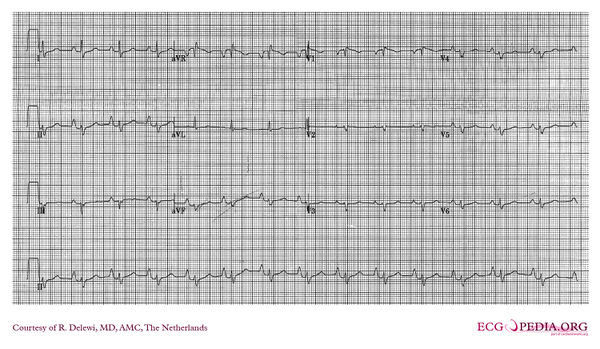 ECG in Congenital Heart Disease - ECGpedia