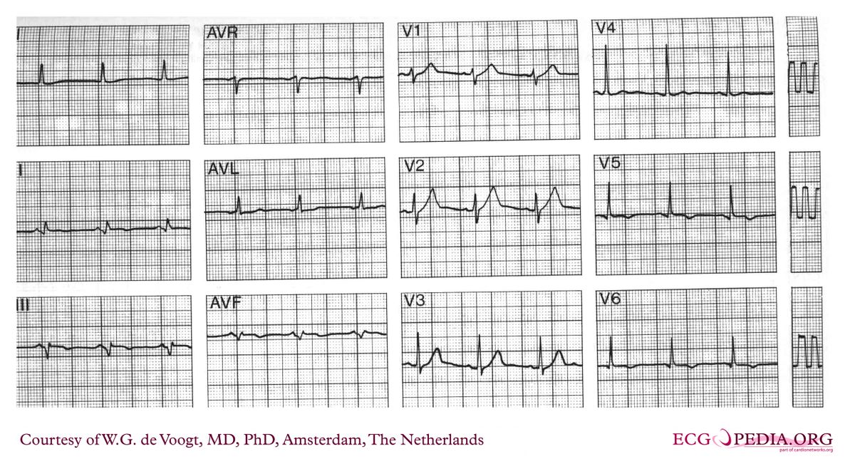 File:DVA2089.jpg - ECGpedia