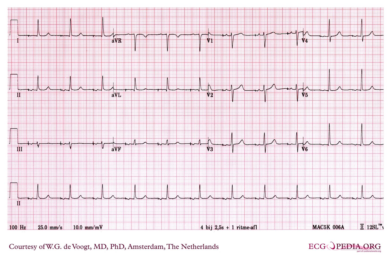 File:DVA0842.jpg - ECGpedia