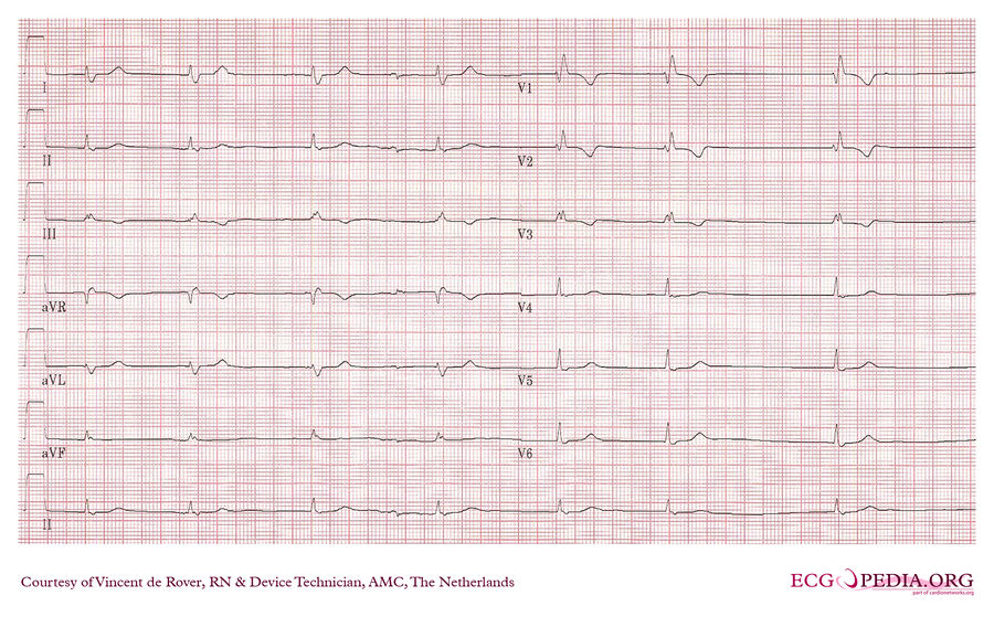 AMC Case 98 - ECGpedia