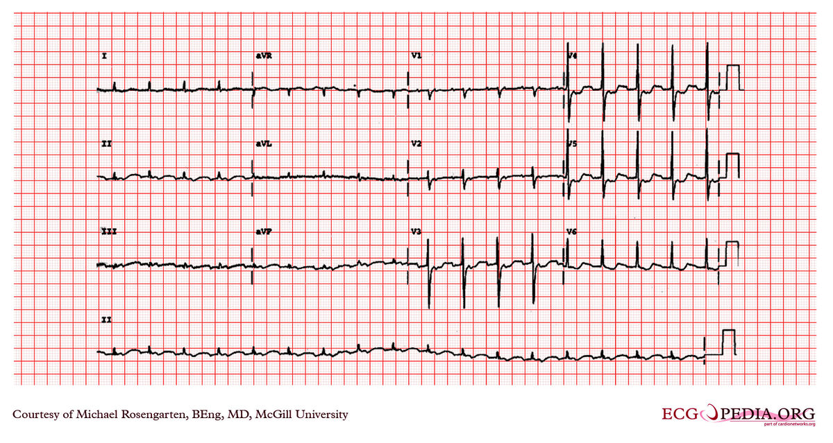 McGill Case 223 - ECGpedia