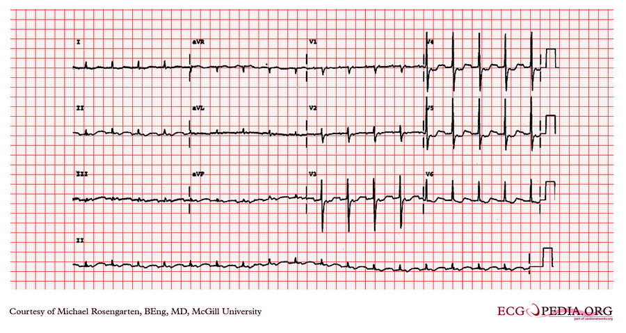 Mcgill Case 223 - Ecgpedia