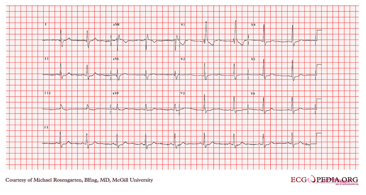 McGill Case 366 - ECGpedia