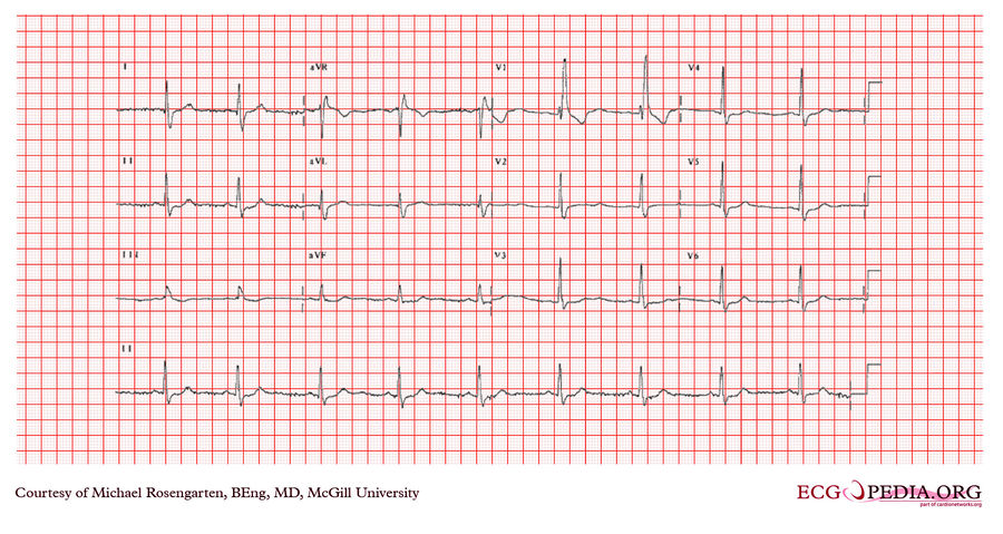 McGill Case 366 - ECGpedia